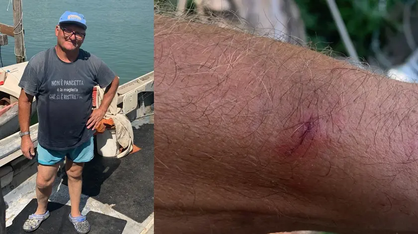 Marino Padovan e una delle ferite che gli sono state inferte dal granchio blu