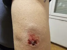 Il vigilante di Jesolo mostra il morso ricevuto nel tentativo di sedare una rissa