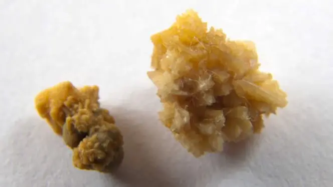 I ladri hanno rubato due calcoli renali, scambiandoli per pietre preziose (foto d'archivio)