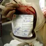 Una sacca di sangue utilizzata per le trasfusioni