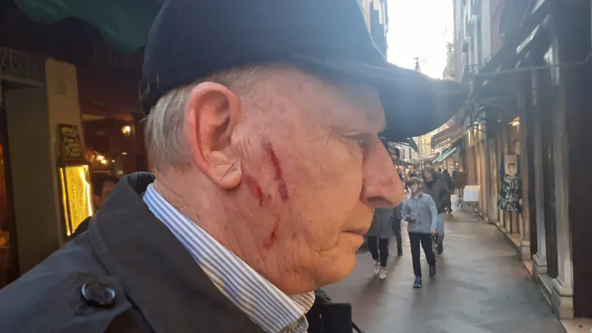L'uomo graffiato al volto dalle due borseggiatrici per punizione