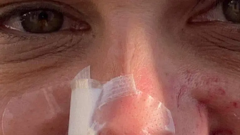 I cerotti sul volto della 34enne aggredita dal bulldog