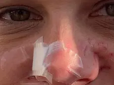 I cerotti sul volto della 34enne aggredita dal bulldog